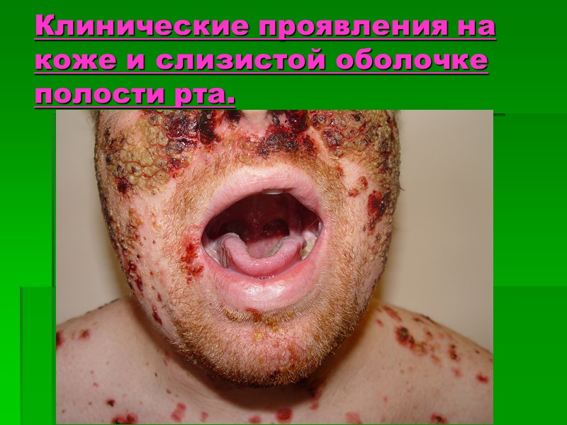 Клинические проявления на коже и слизистой оболочке полости рта.